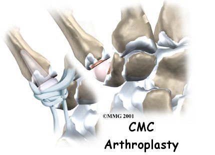 Artificial Joint Replacement of the Thumb - Next Step Physio's Guide