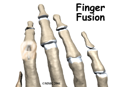 Finger Fusion Surgery - Next Step Physio's Guide