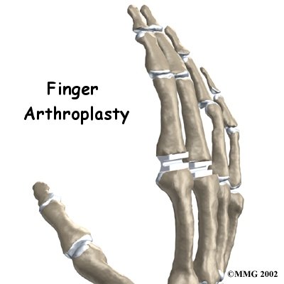 Artificial Joint Replacement of the Finger - Next Step Physio's Guide